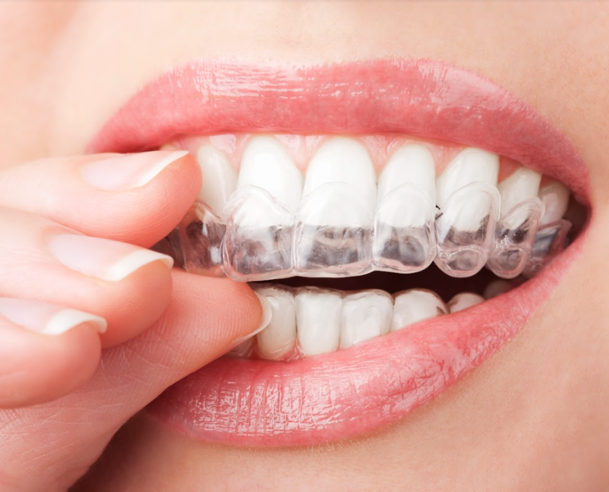 close up of woman using clear aligners in Anderson