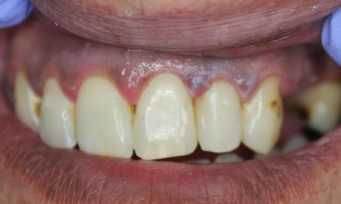 front tooth after being restored with dental filling