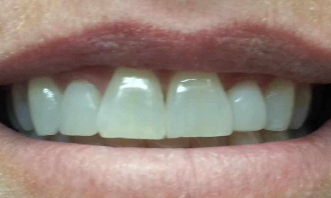 bright front teeth after teeth whitening