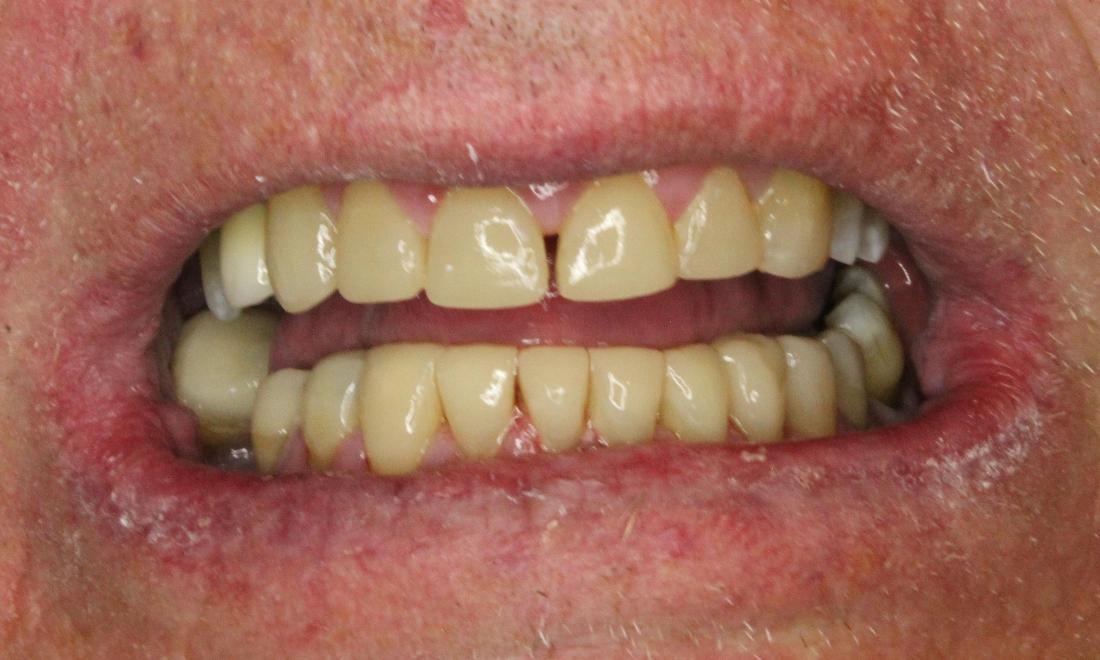 Composite reconstruction of worn teeth in anderson