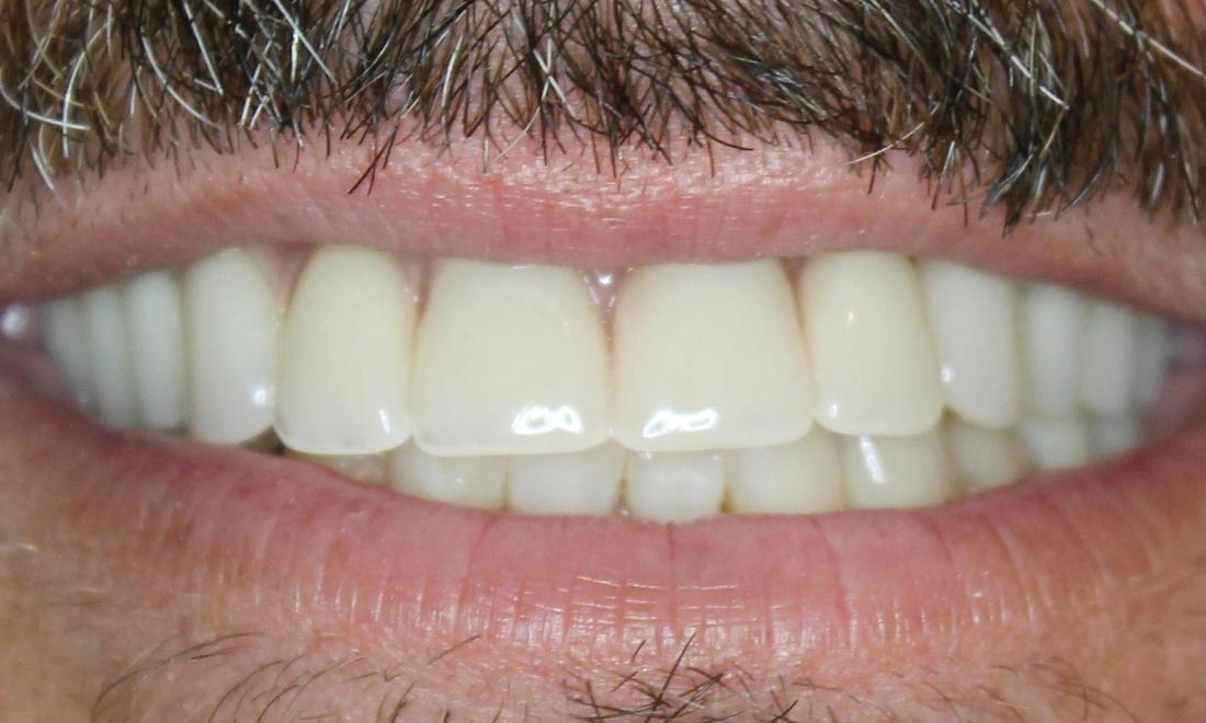new dentures on top and new partials on bottom of this patient's smile