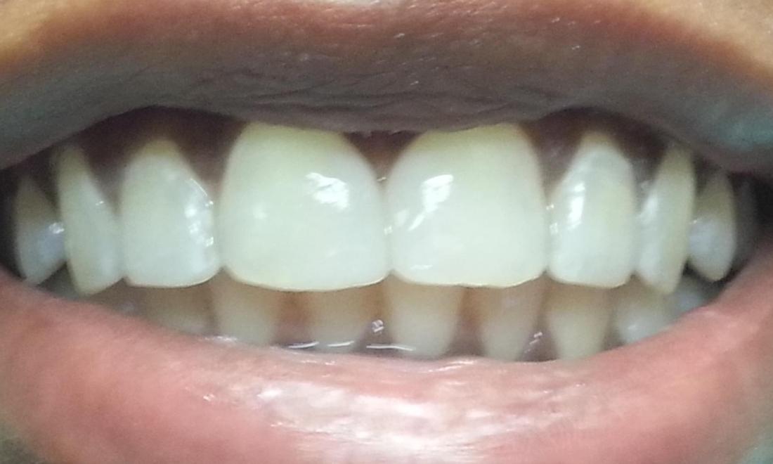 composite used to close space on front teeth