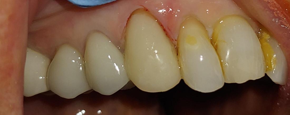 direct composite used to repair broken tooth