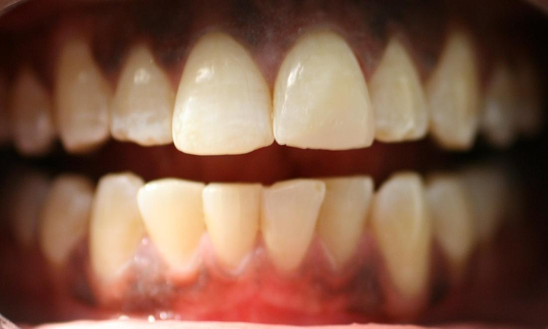 broken front tooth restored