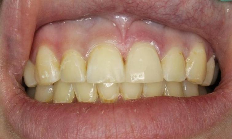 Front tooth after dental bonding