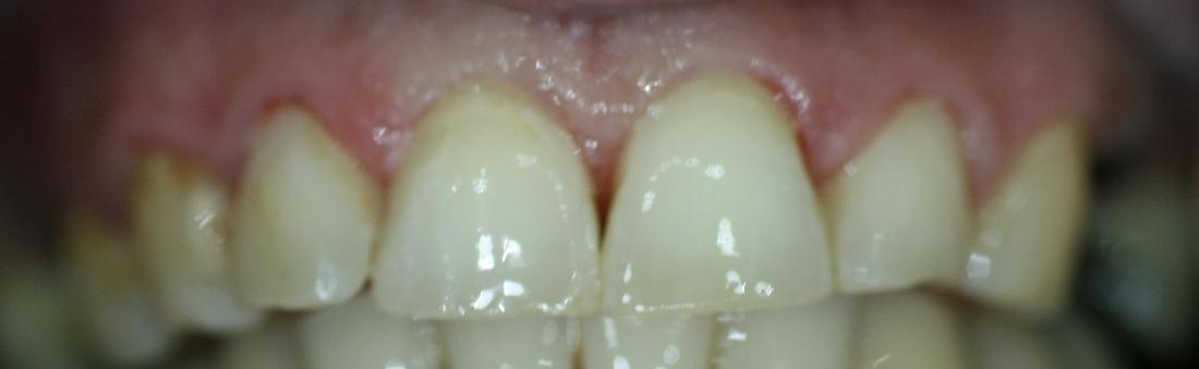 Dentist In Anderson SC Smile Gallery Front Tooth Filling