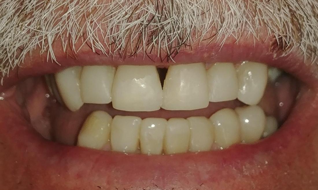 male patient's smile after restoration in anderson sc