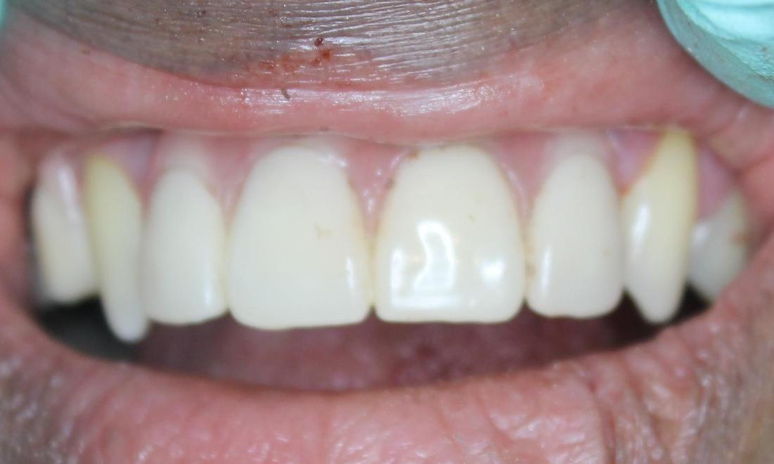 partial denture used after tooth extraction