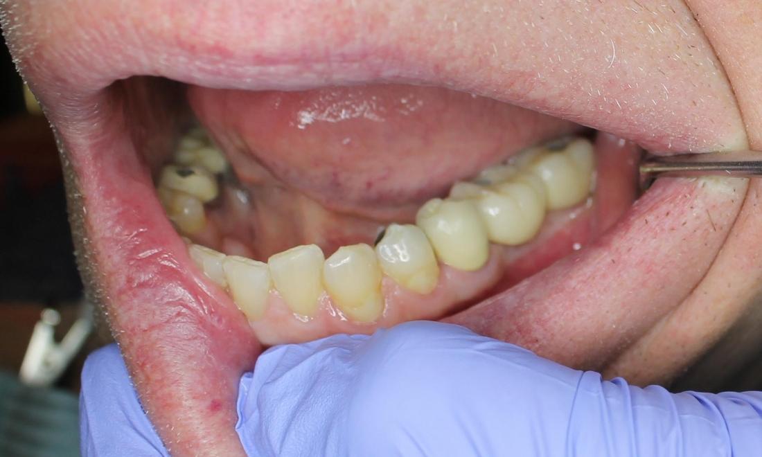 dental new dental crowns restored back implants