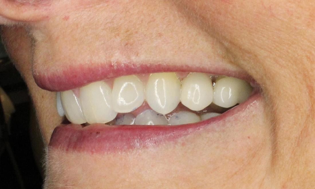 new dental implant after cracked molar was extracted