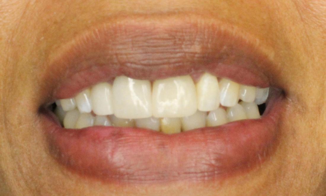 new ceramic crowns