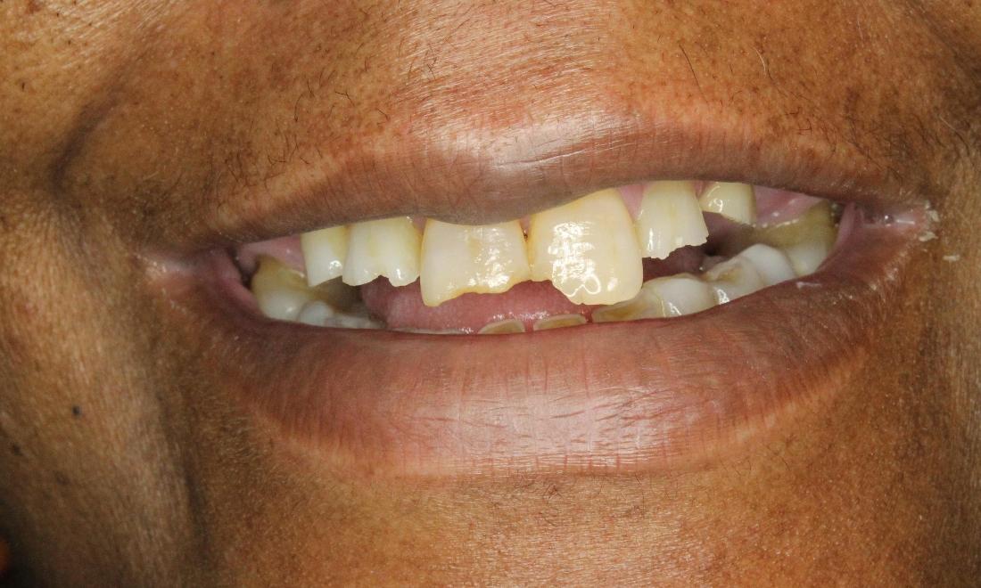 worn front teeth