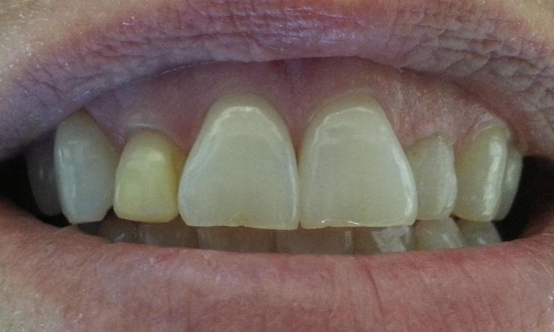 yellowed front teeth before whitening