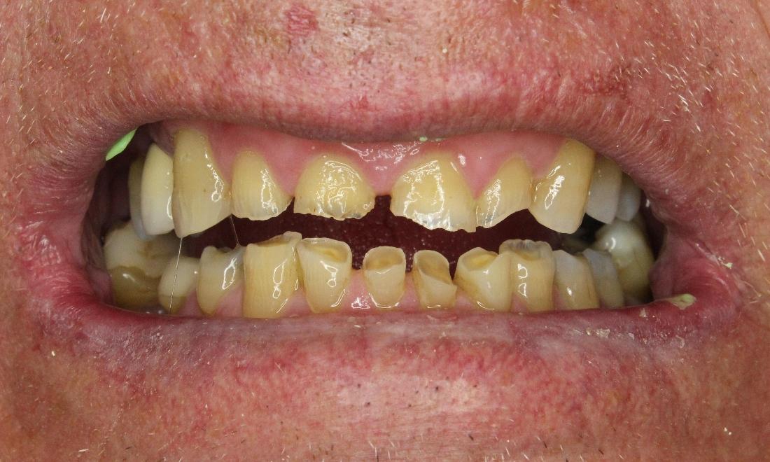 Severely worn teeth of patient in anderson sc