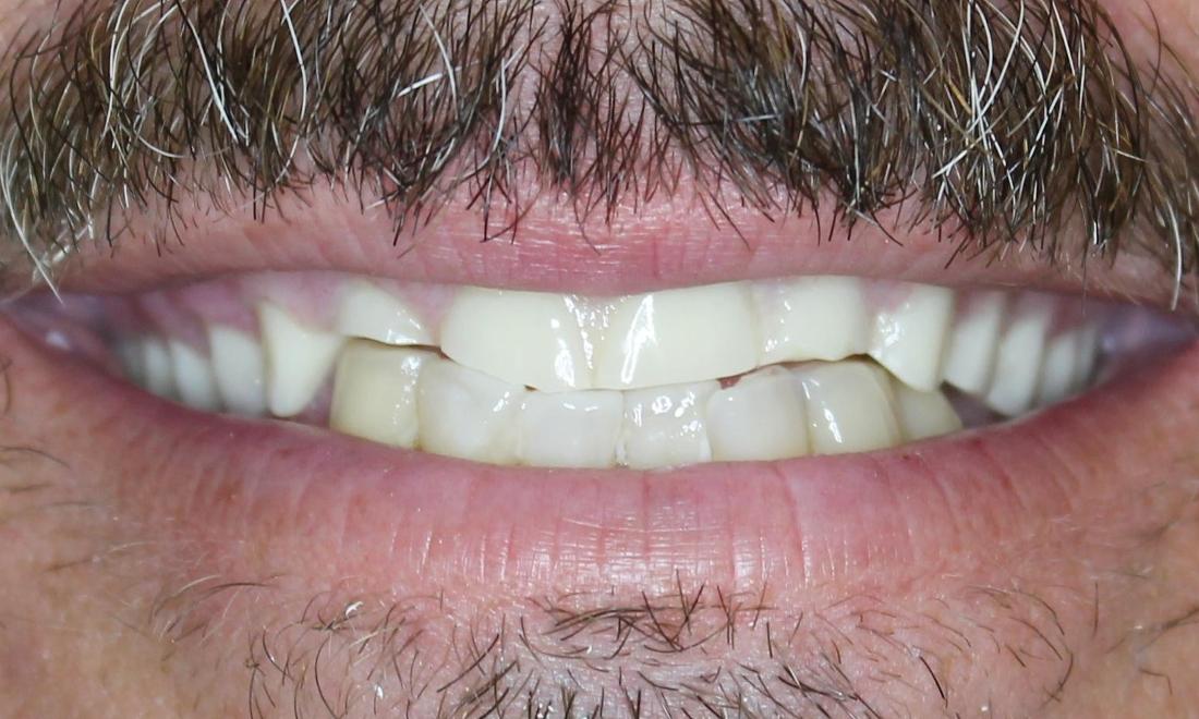worn dentures