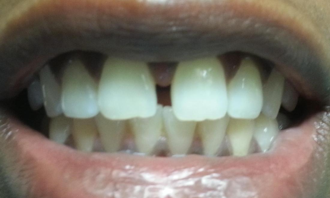 space between front teeth
