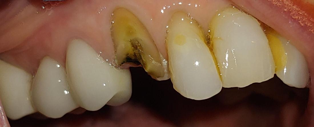 fractured canine tooth before repair 