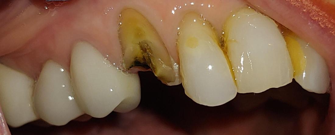 Before & After Photos, Cracked Tooth Repair Gallery