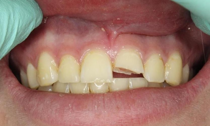 Broken front tooth before dental bonding
