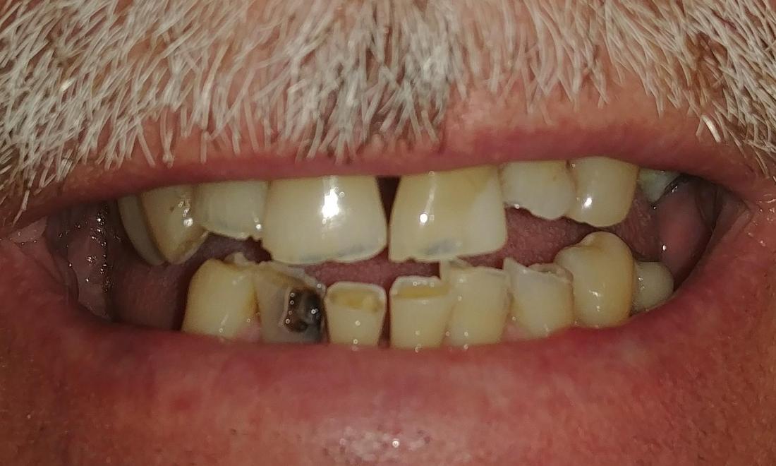 close up of male patient's smile with broken and worn teeth