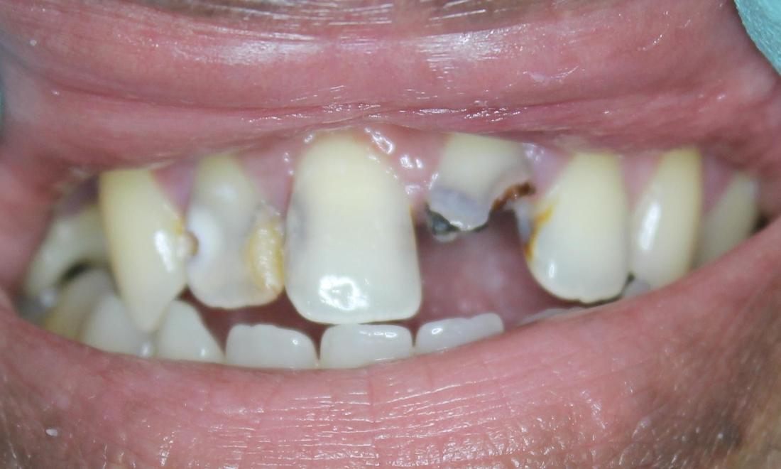 multiple broken teeth before tooth extraction