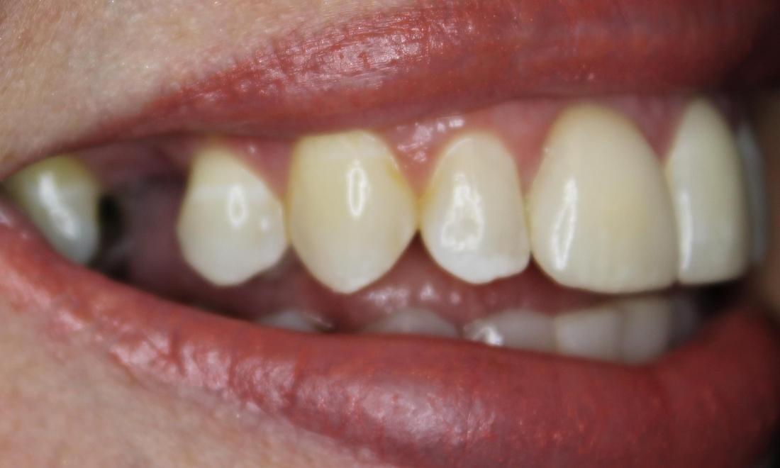 missing back tooth 