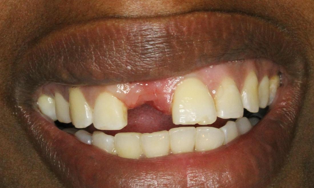 Implant and crown before image