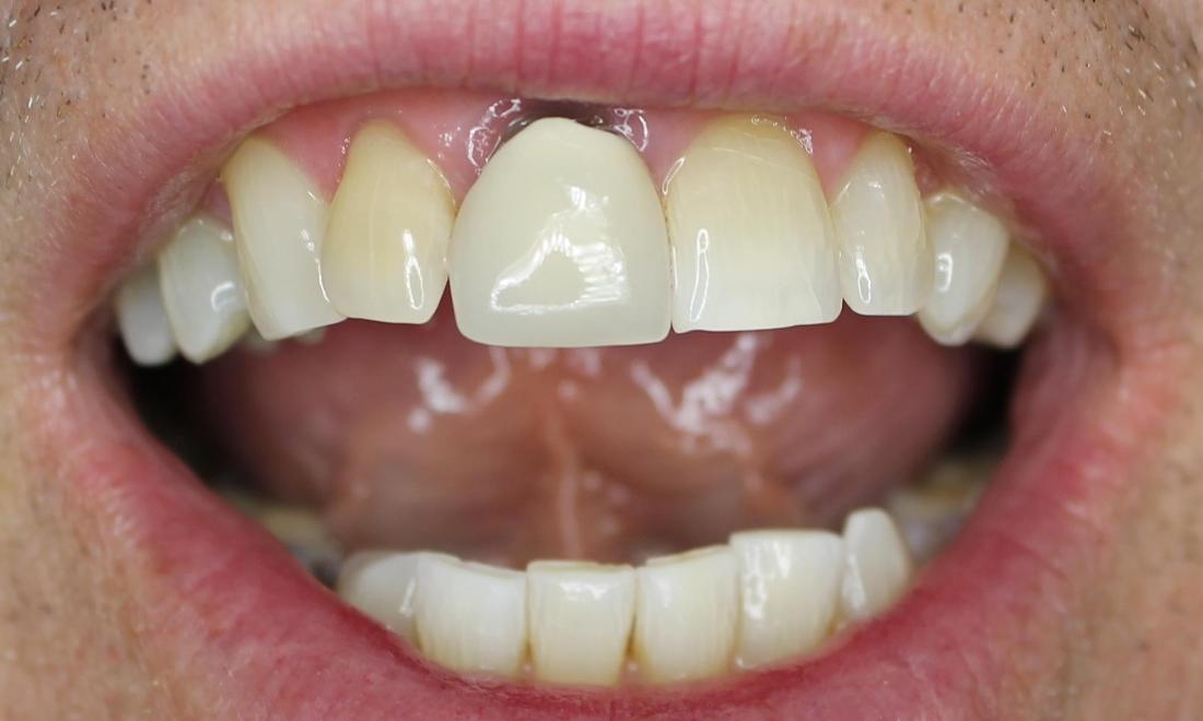 crown on front tooth showing gumline