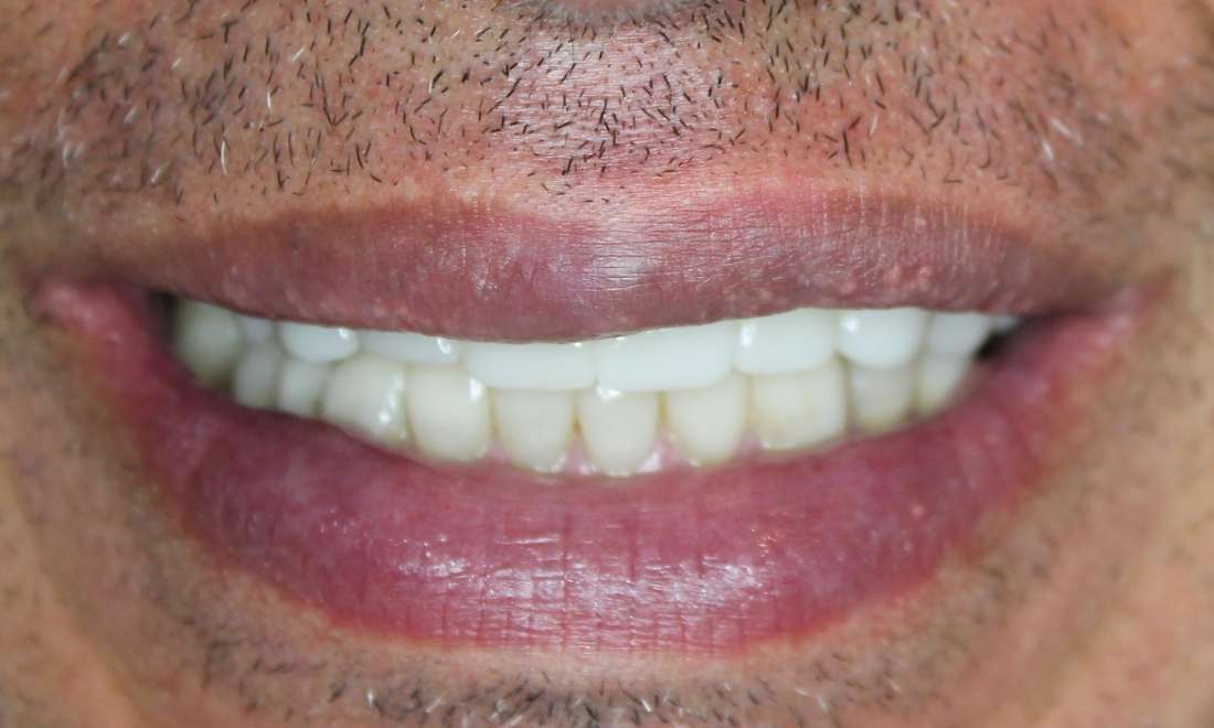 close up of smile after crowns to replace missing tooth