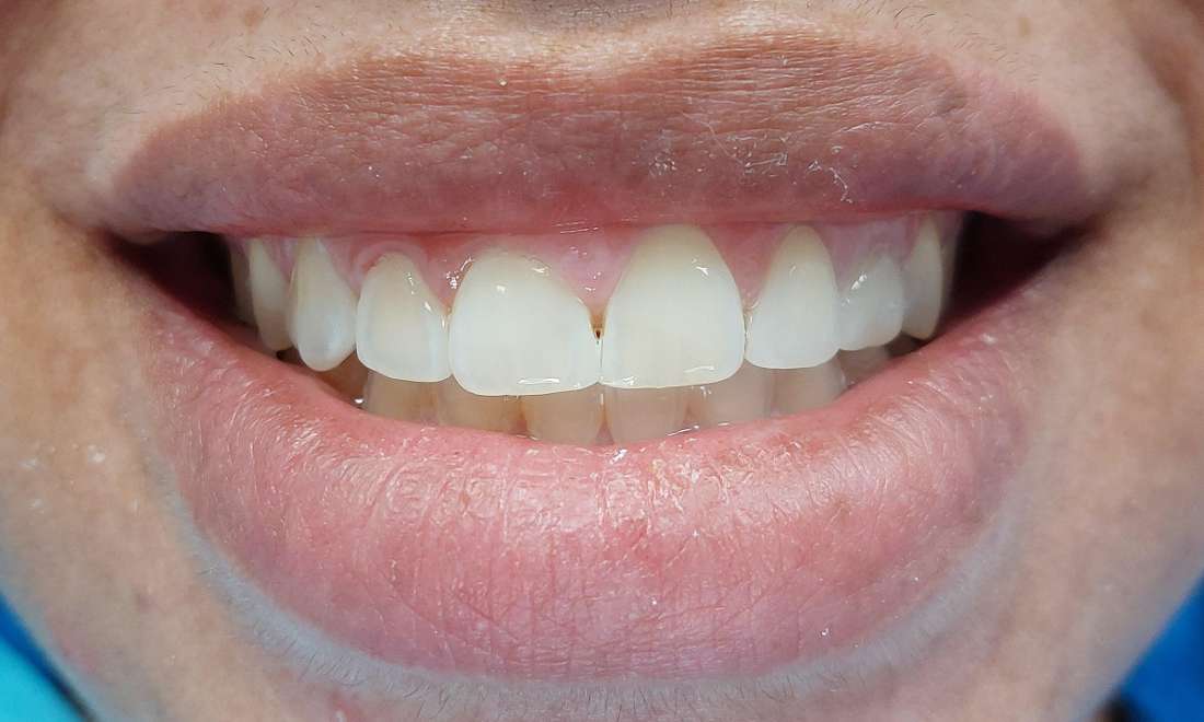 dental bonding used to close gap between top front teeth