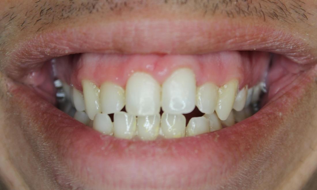 tooth after teeth bleaching