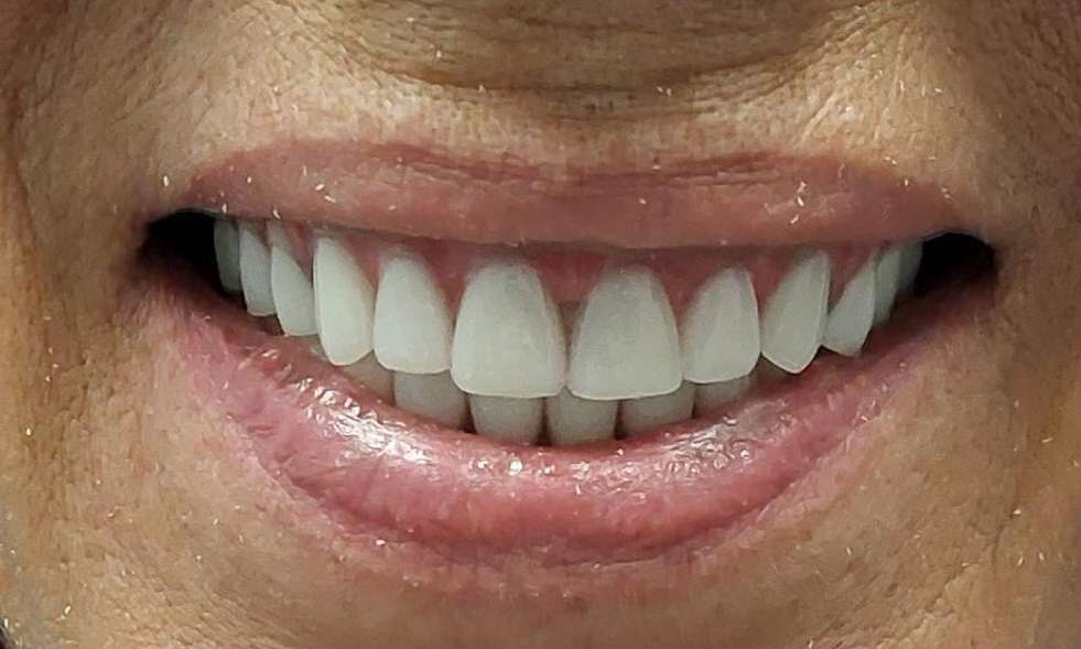 Snap On Dentures after