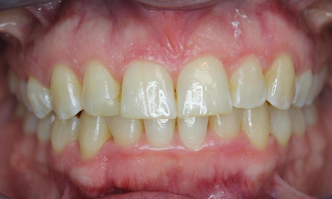 Facial After aligners in anderson 
