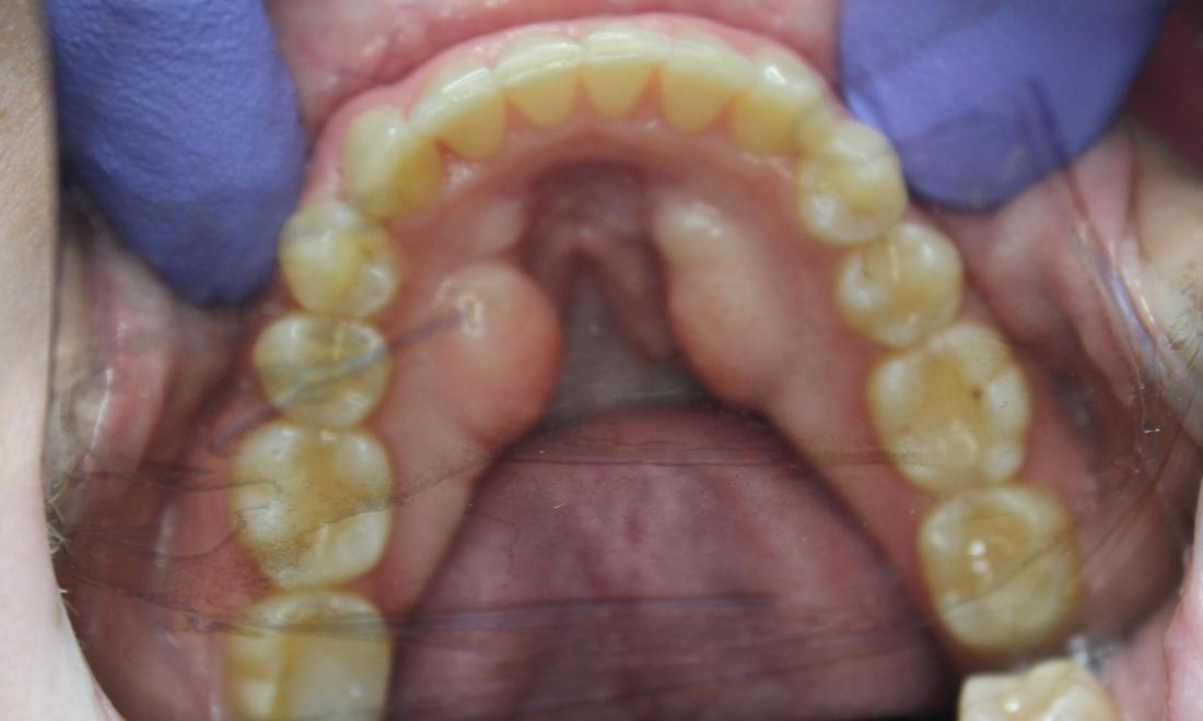 lower teeth after aligners