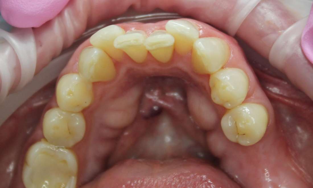 crooked teeth in lower jaw before Aligner Teeth Straightening 