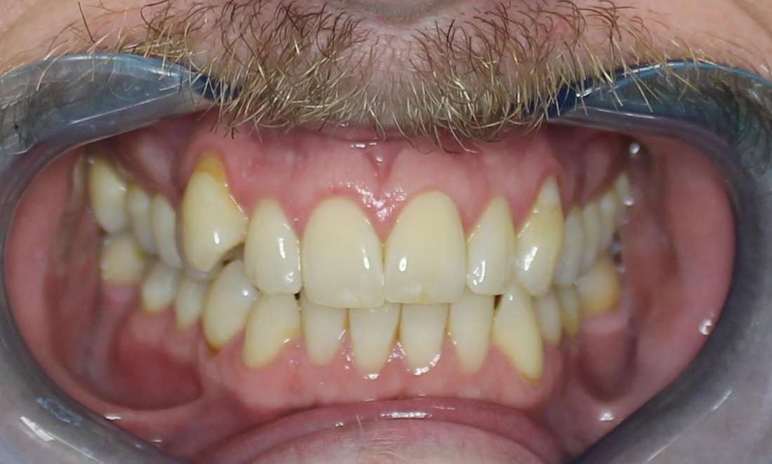 patient with crooked tooth before clear aligners 