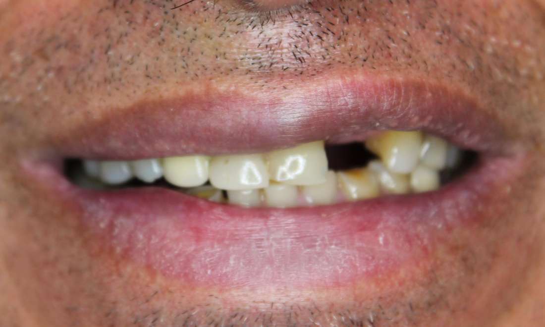 close up of smile with worn teeth and one missing top tooth