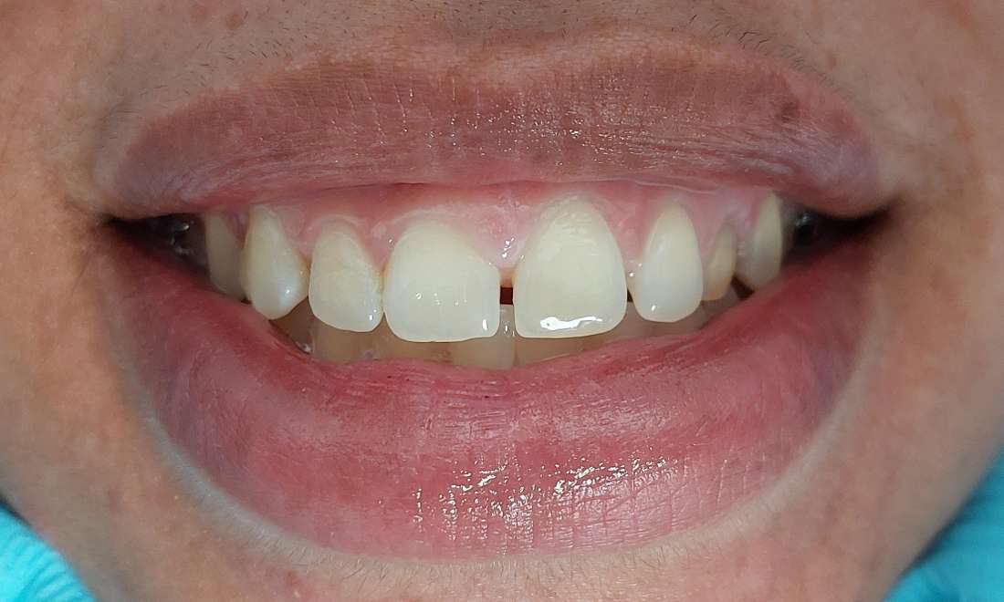 patient with gap between top front teeth