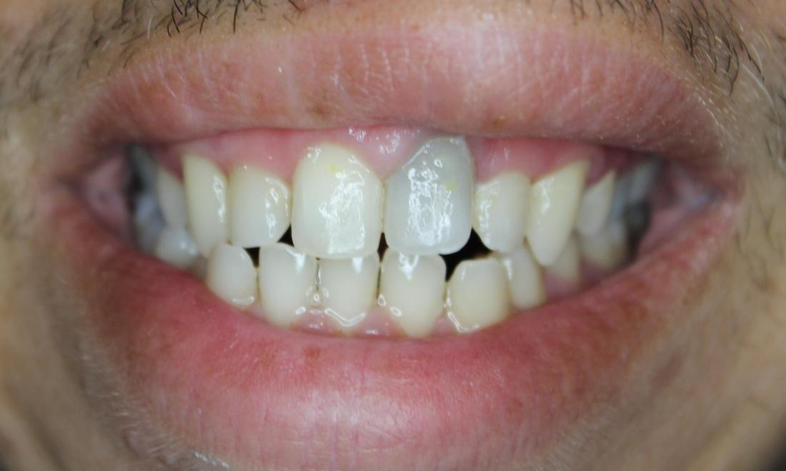 gray tooth after root canal