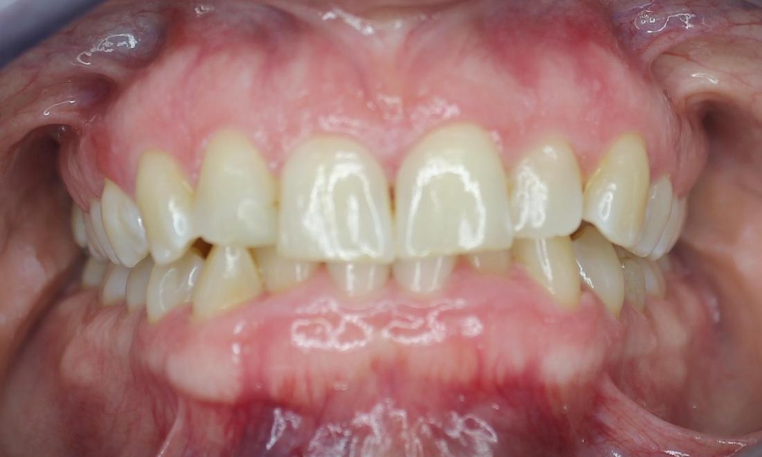 teeth Before aligners in anderson