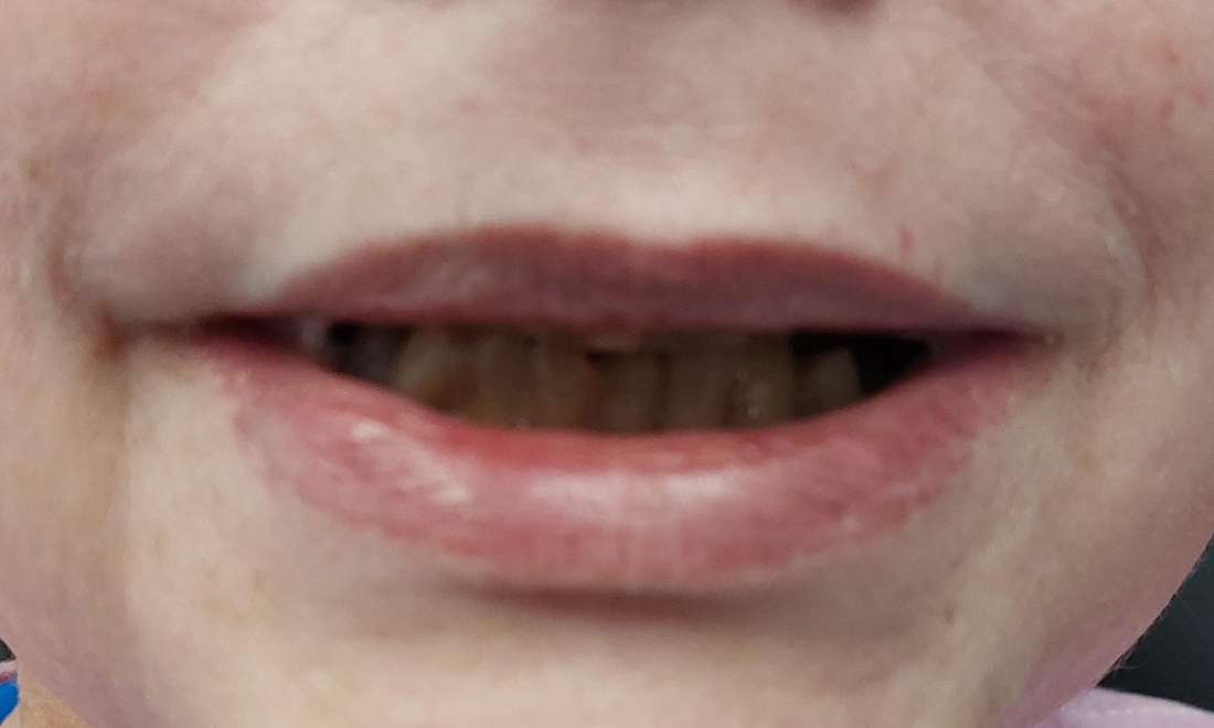 patient hiding smile before tooth replacment