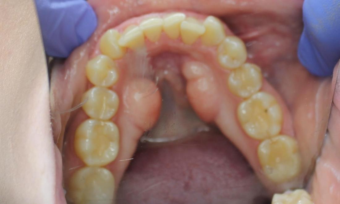 lower teeth before aligners in anderson sc