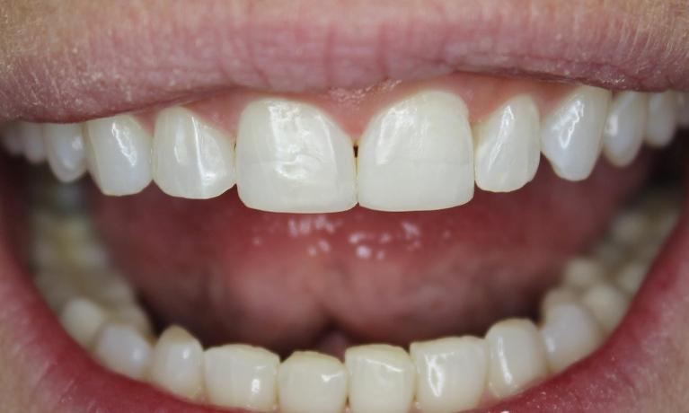 Tooth after being restored with composite