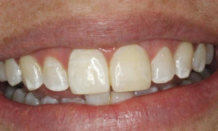After reshaping and new bonding on tooth