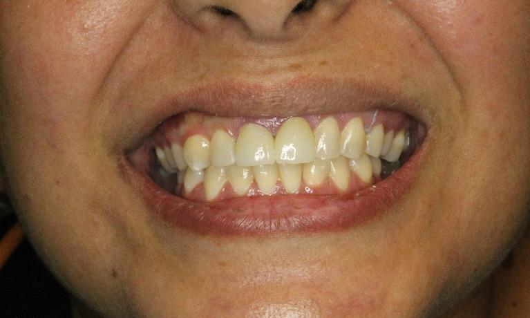 woman's smile after crowns and bonding used