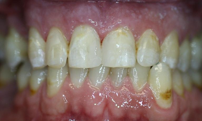 bright smile after dental fillings used to transform smile
