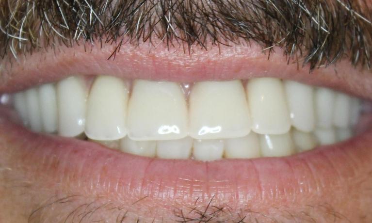 New-Denture-and-Partial-After-Image