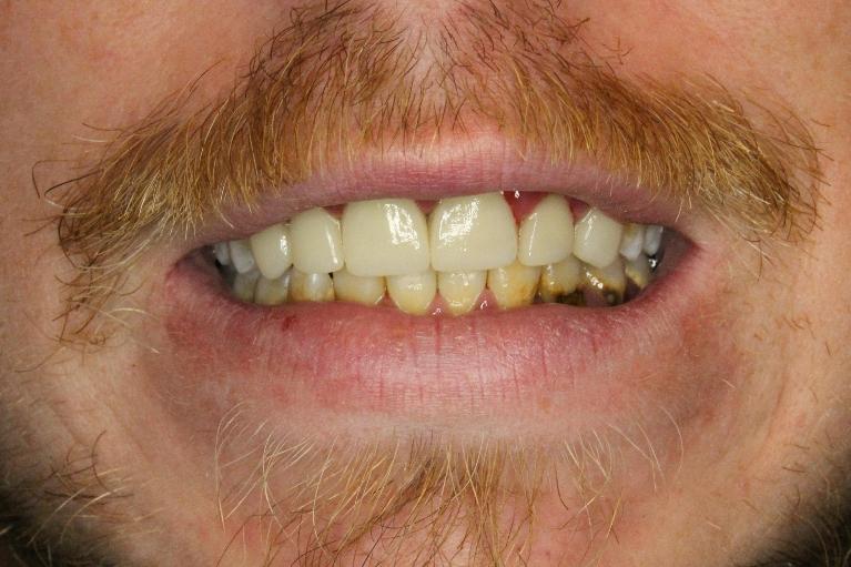 dental crowns used to protect decayed teeth