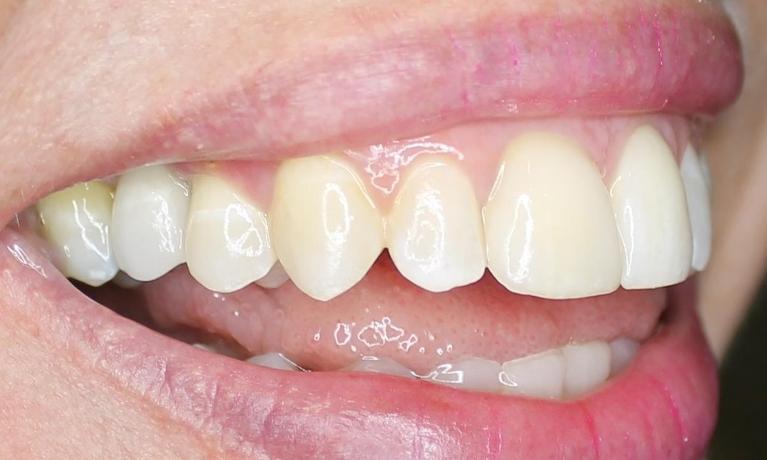 dental implant and crown used to replace missing tooth