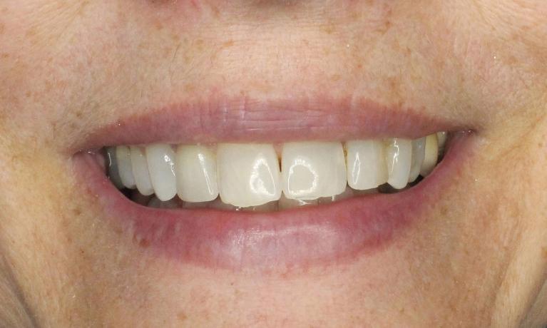 new ceramic dental crowns